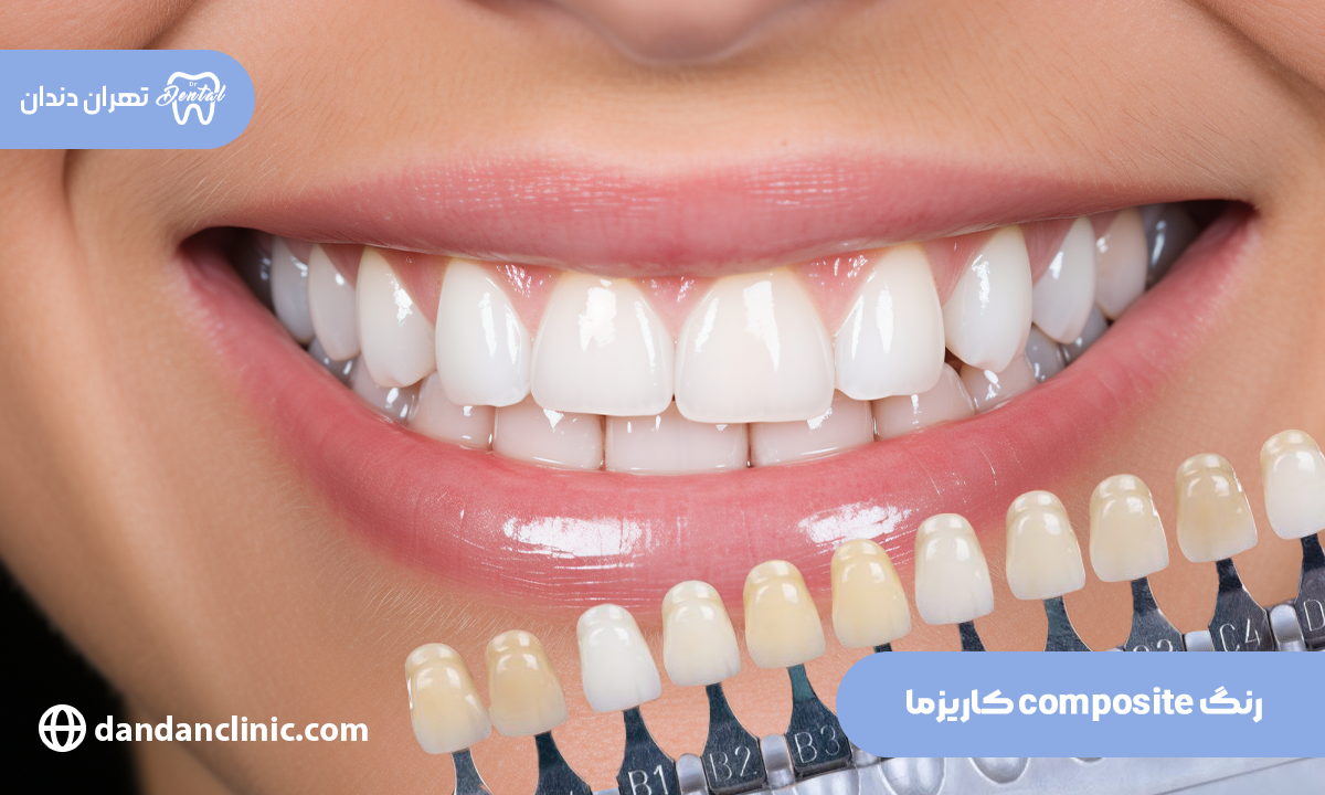 کامپوزیت کاریزما، ماندگاری و طول عمر و دارای کیفیت بسیار عالیست